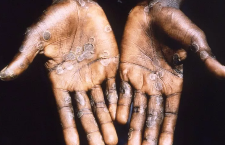 Monkeypox Spread Highlights Need to Take all Necessary Steps to Prevent Zoonotic Spillover of Viruses