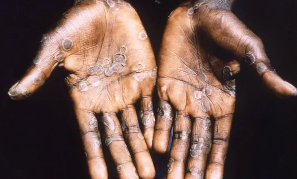 Monkeypox Spread Highlights Need to Take all Necessary Steps to Prevent Zoonotic Spillover of Viruses